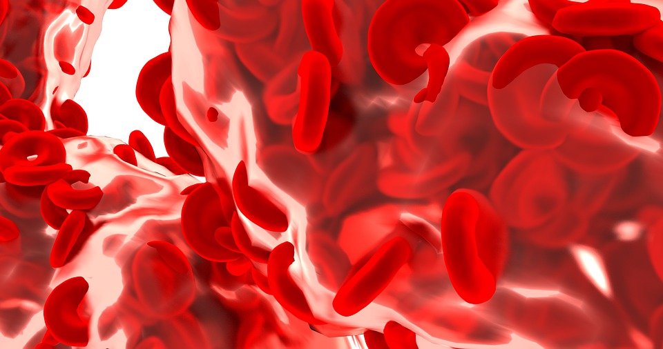 Niedokrwistość (anemia) syderoblastyczna – przyczyny, objawy, diagnostyka, leczenie, powikłania